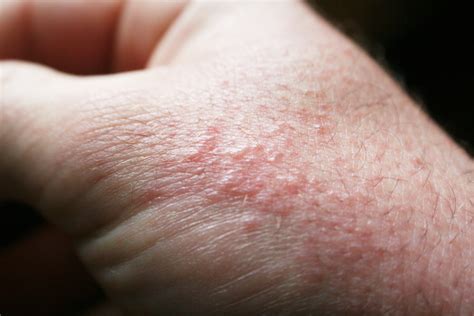 red rash after perfume exposure